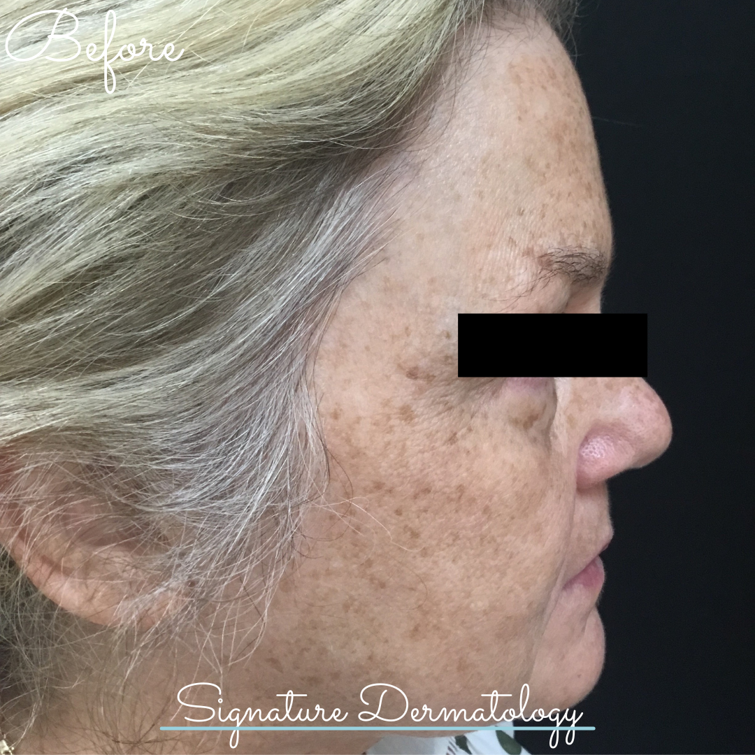 Before & After: BBL to the décolletage – Port Macquarie Dermatology